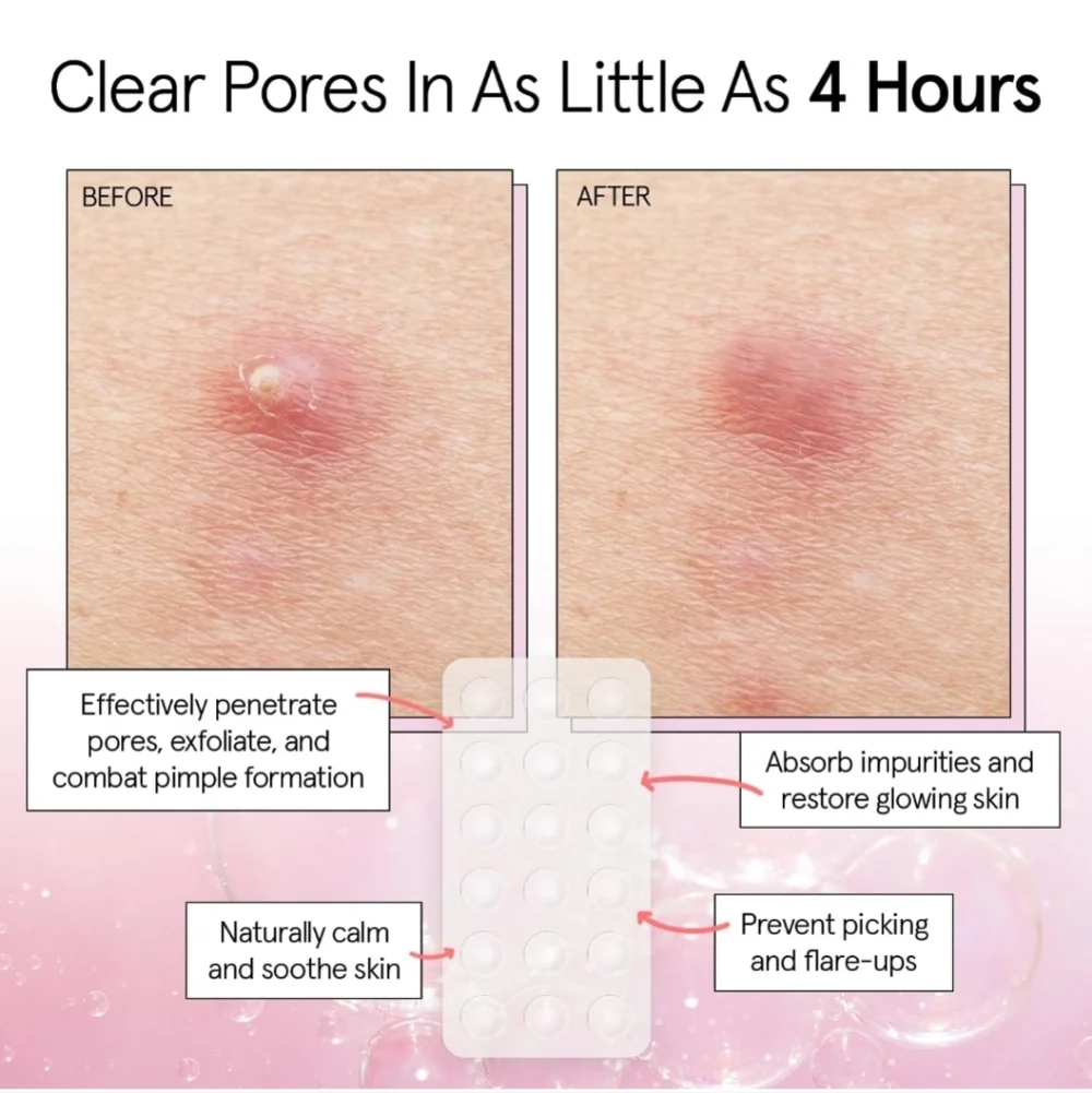 2 pck Pimple Patches for Face